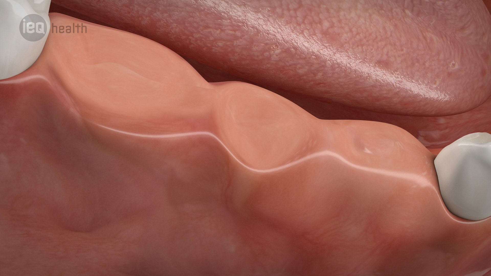 Implantatgetragene Brücke 01