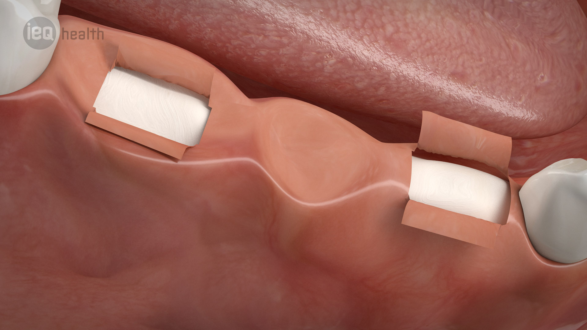 Implantatgetragene Brücke 02