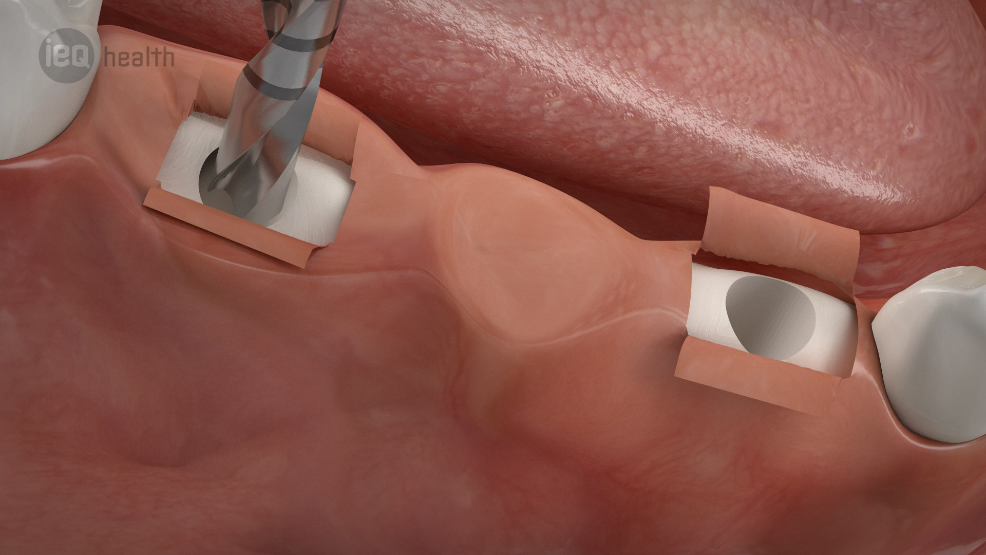 Implantatgetragene Brücke 03