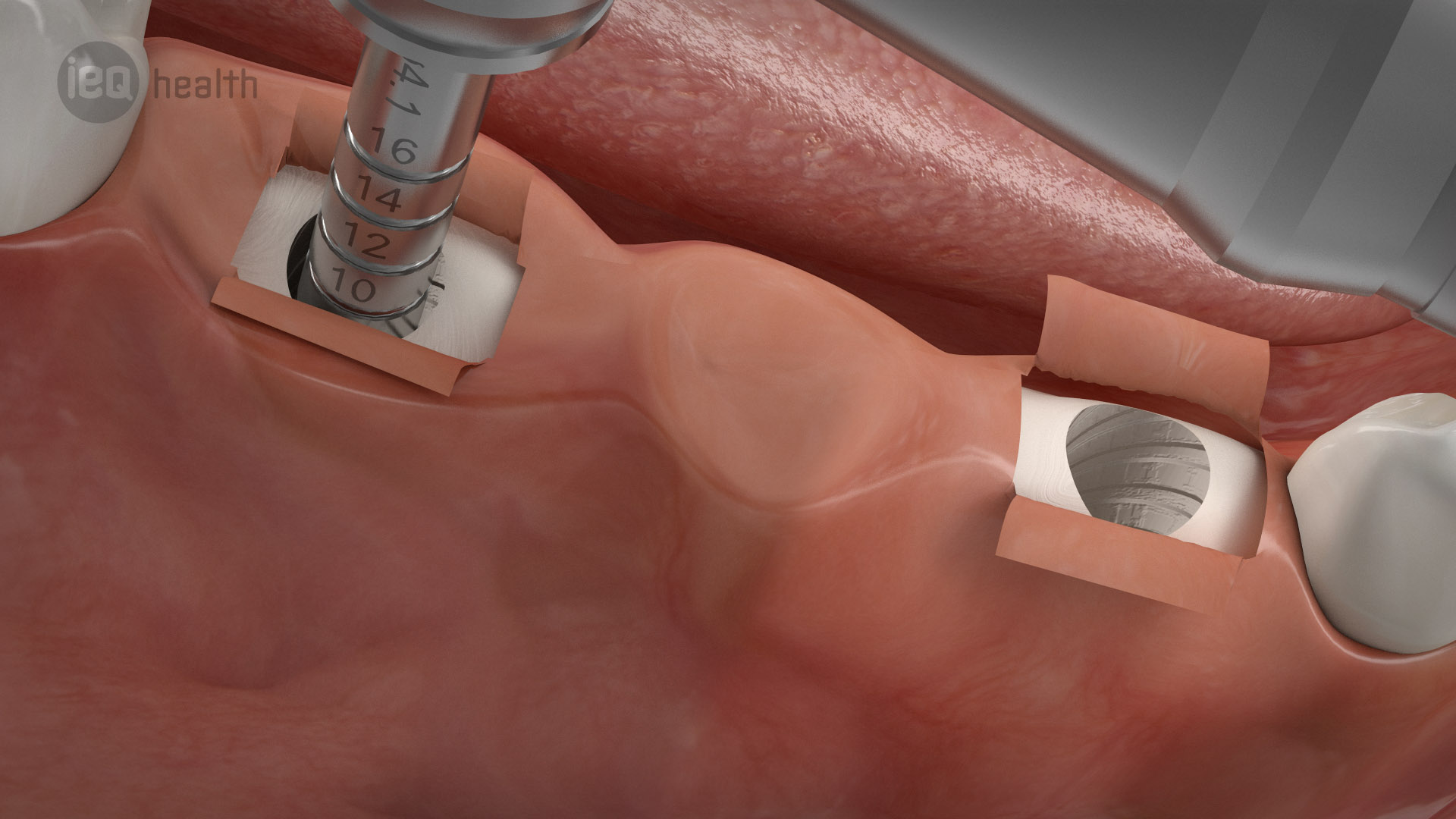 Implantatgetragene Brücke 04