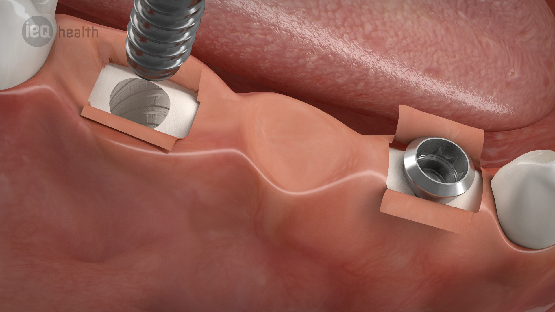Implantatgetragene Brücke 05