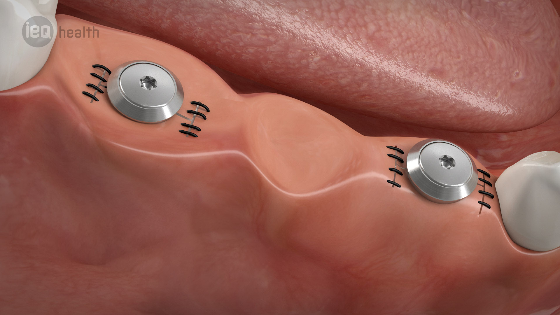 Implantatgetragene Brücke 06