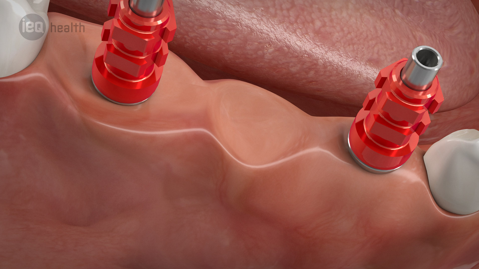 Implantatgetragene Brücke 07