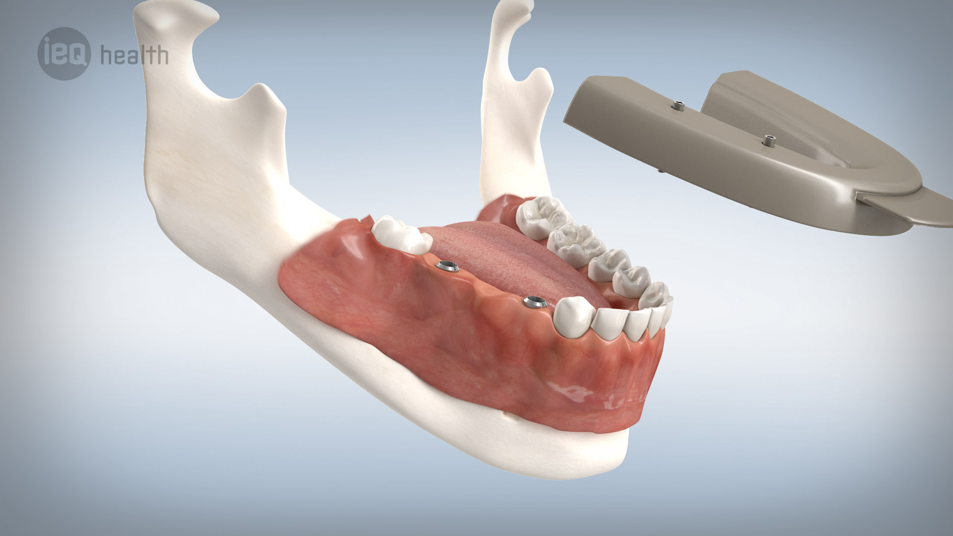 Implantatgetragene Brücke 09