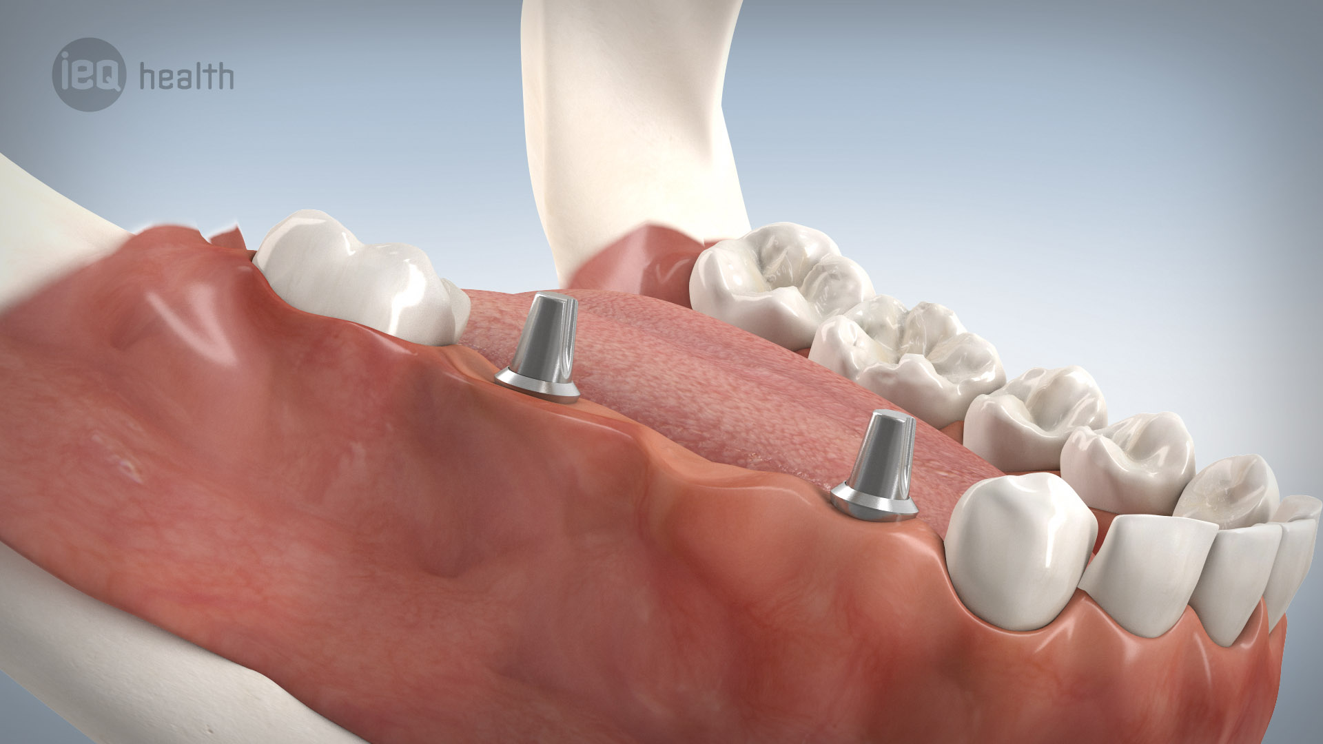 Implantatgetragene Brücke 10