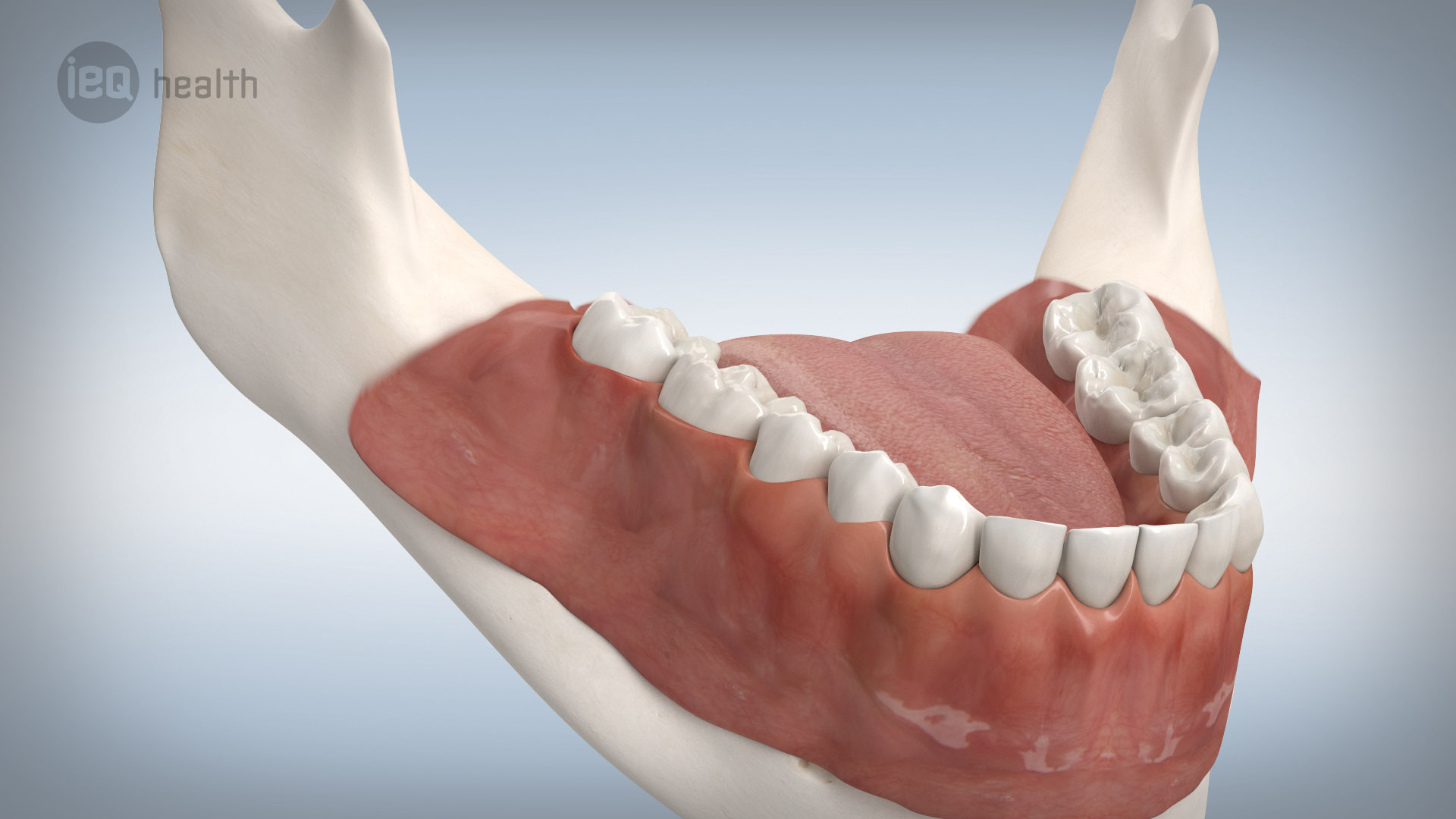 Implantatgetragene Brücke 12