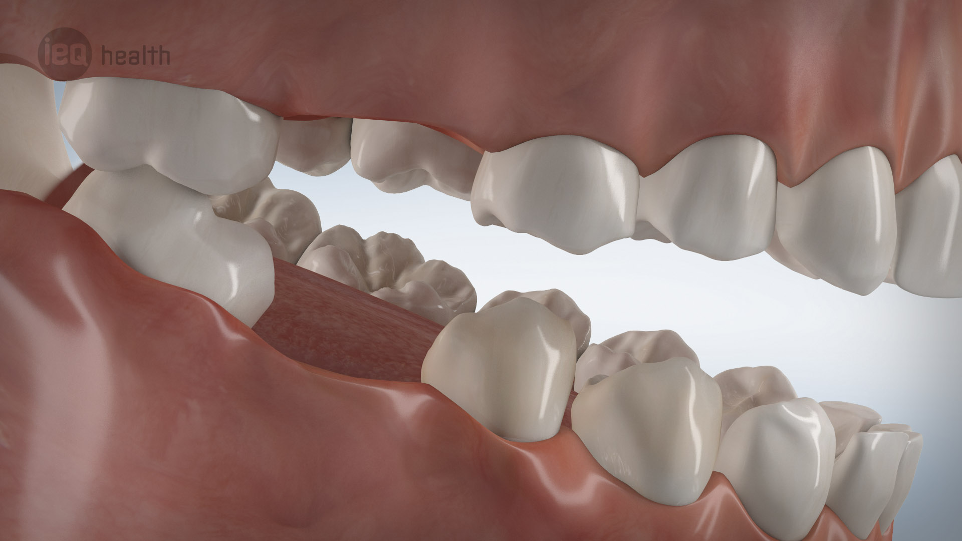 Verlust einzelzahn 07