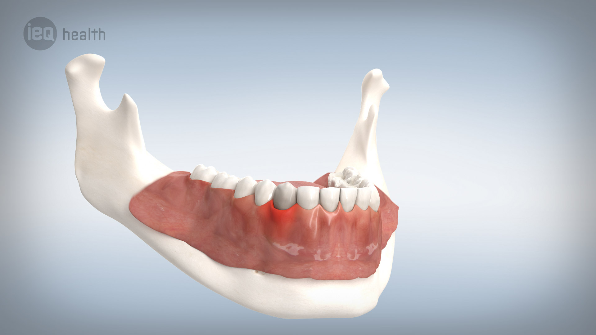 Parodontitisbehandlung 01