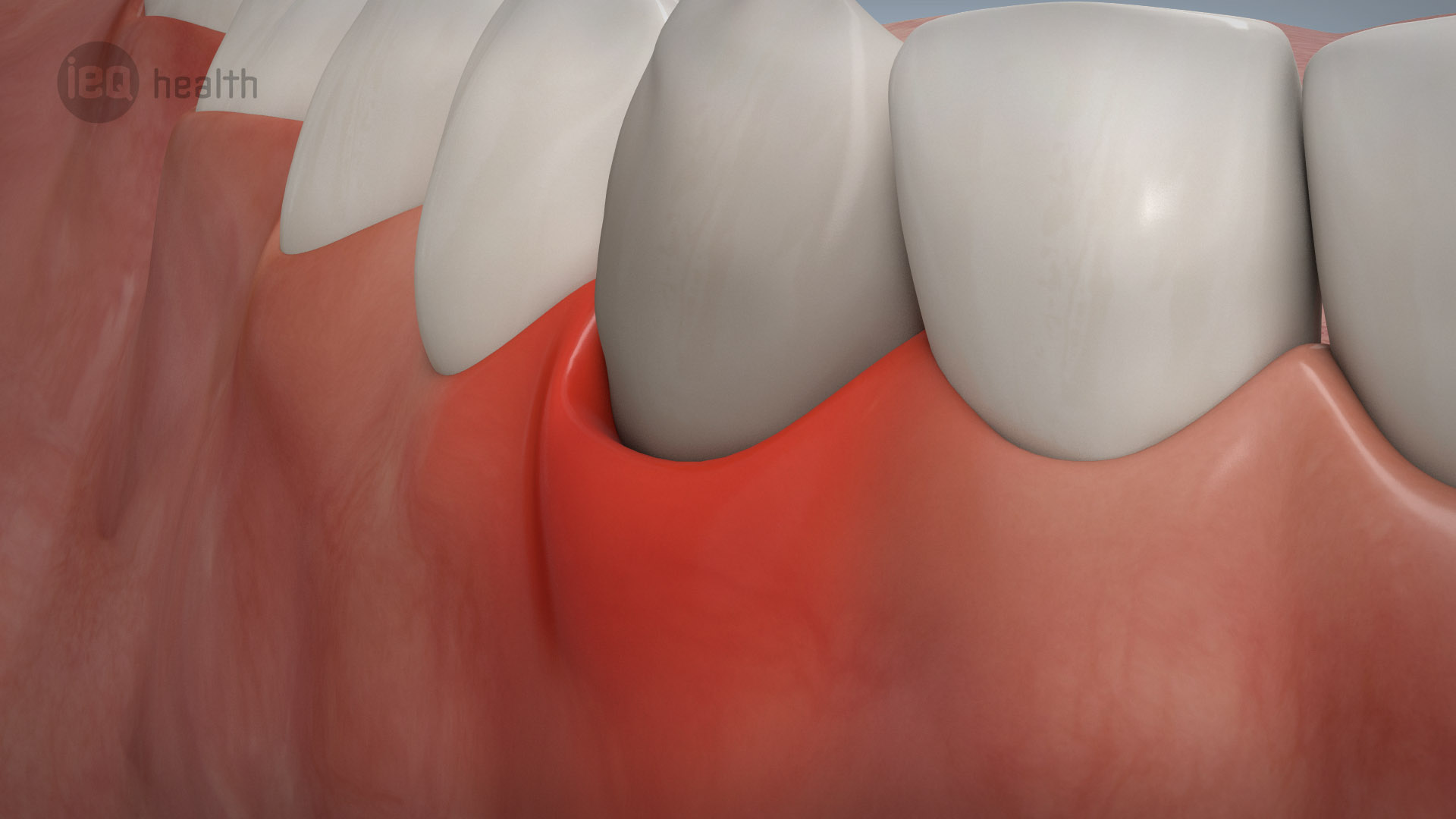Parodontitisbehandlung 02
