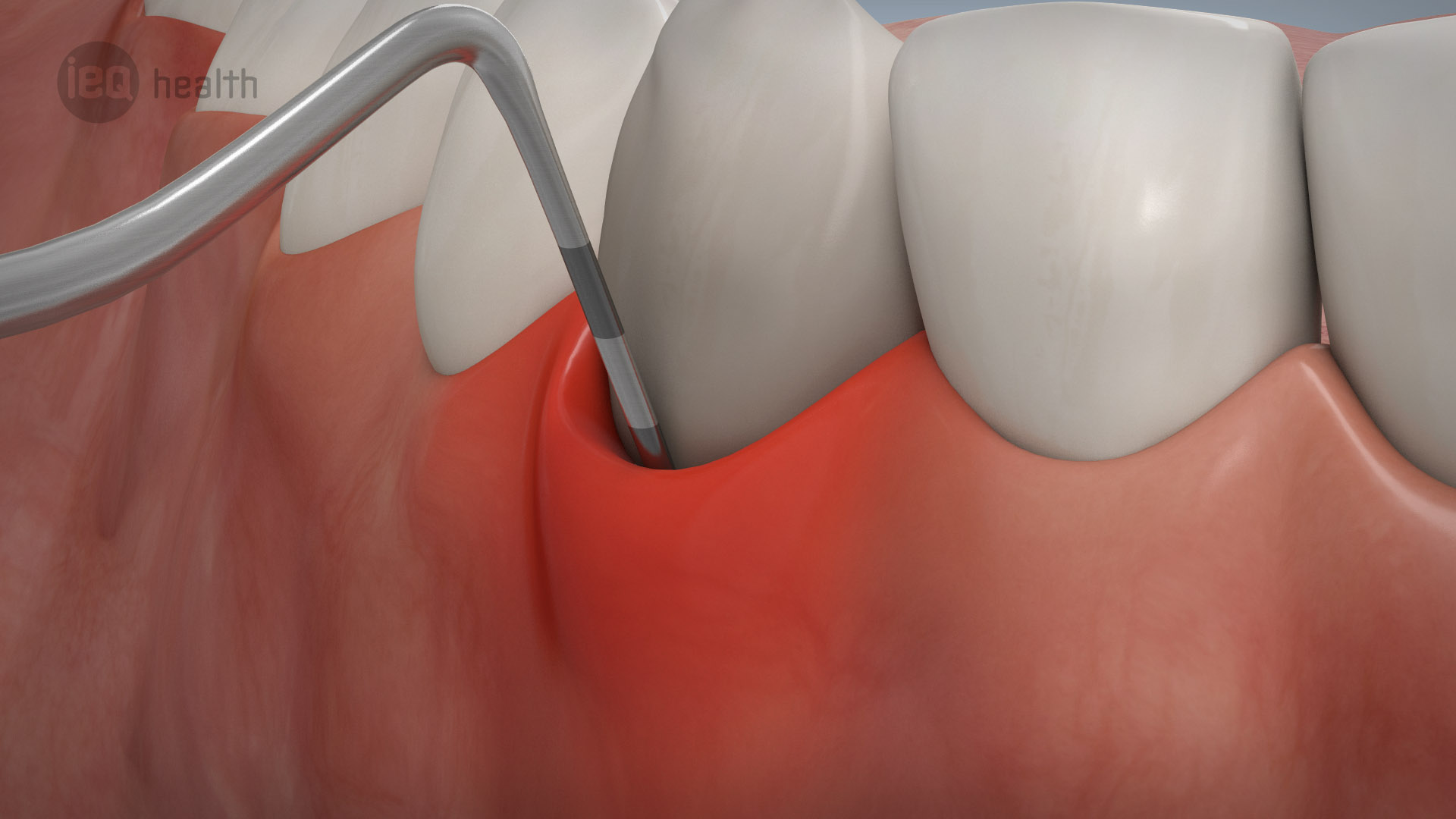 Parodontitisbehandlung 04