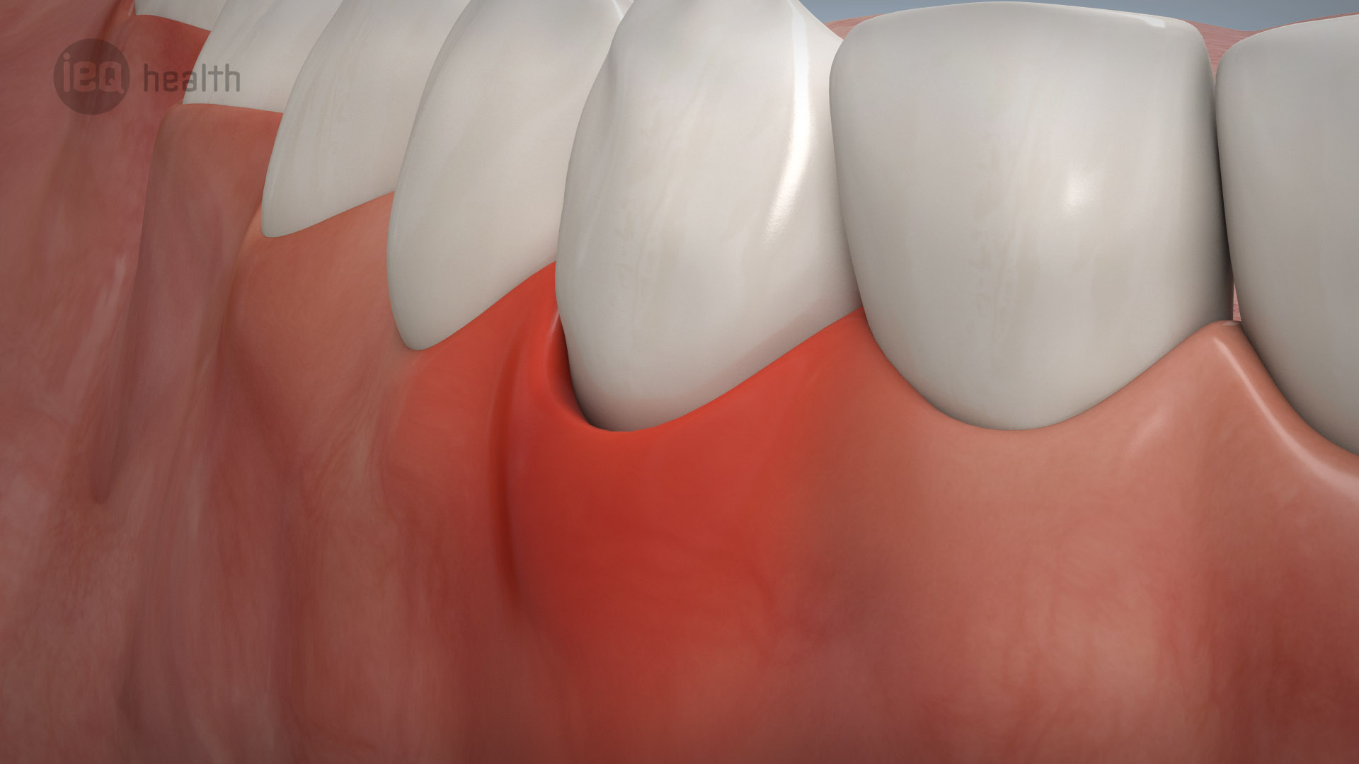 Parodontitisbehandlung 09